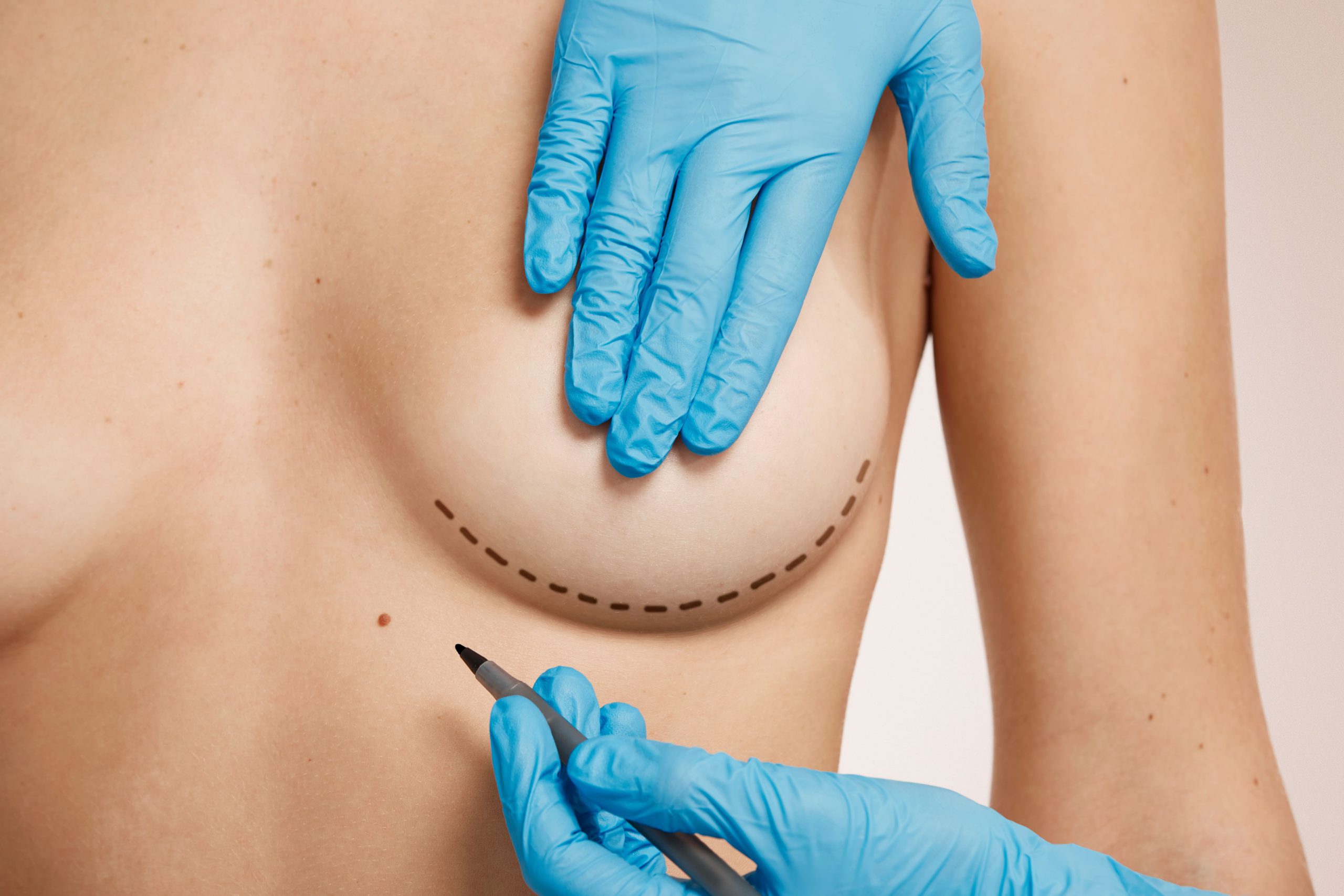 Breast Conservation Surgery | Breast Cancer Specialist in Pune Breast Conservation Surgery | Breast Cancer Specialist in Pune